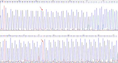 Case report: Identification of a frameshift mutation in GC enrichment and the GCC repeat region of the androgen insensitivity receptor (AR) gene in a patient with complete androgen insensitivity syndrome by whole-exome sequencing (WES) combined with specific PCR and deep sequencing